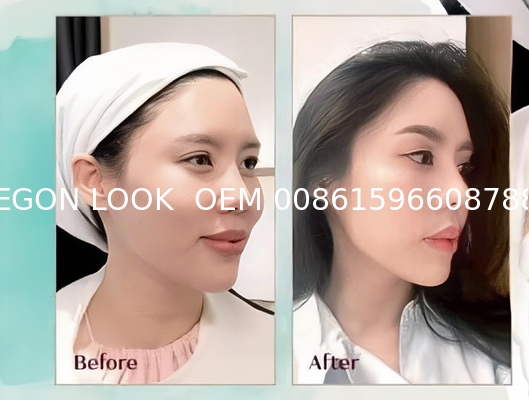 REGEN LOOK Poly L Lactic Acid Plla Dermal Filler for Collagen Regeneration